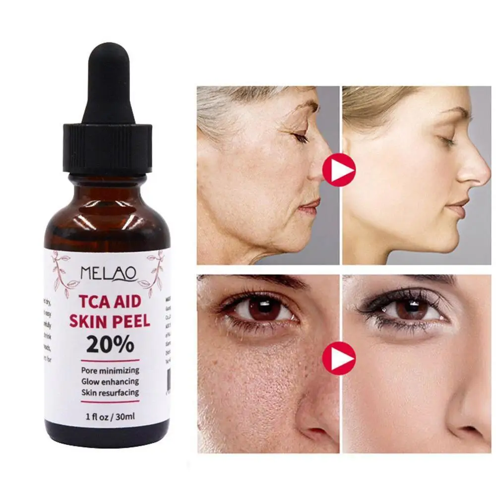 30 ml Trichloroaectic Acid 20% Skin Peel Pore Minizing Rynker Spots Skin Care Face Serum 0