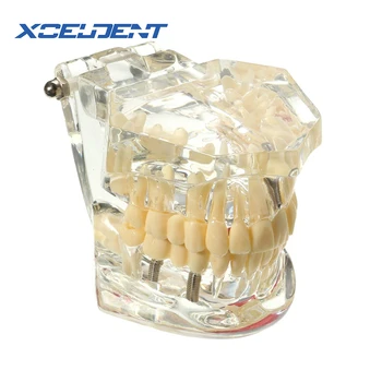 1stk tandimplantat Sygdom Tænder Model Med Restaurering Bro Tand Tandlæge For Medicinsk Videnskab tandsygdomme Undervisning Undersøgelse 0