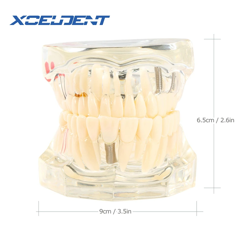 1stk tandimplantat Sygdom Tænder Model Med Restaurering Bro Tand Tandlæge For Medicinsk Videnskab tandsygdomme Undervisning Undersøgelse 1
